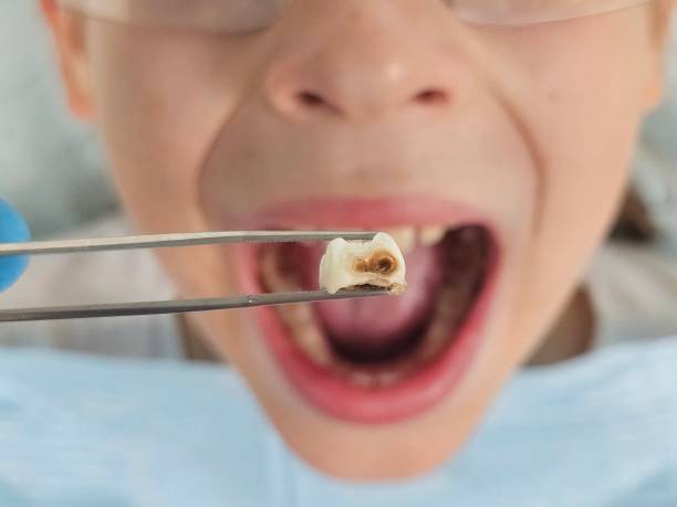 Best Dental Abscess Treatment in Albany, WI